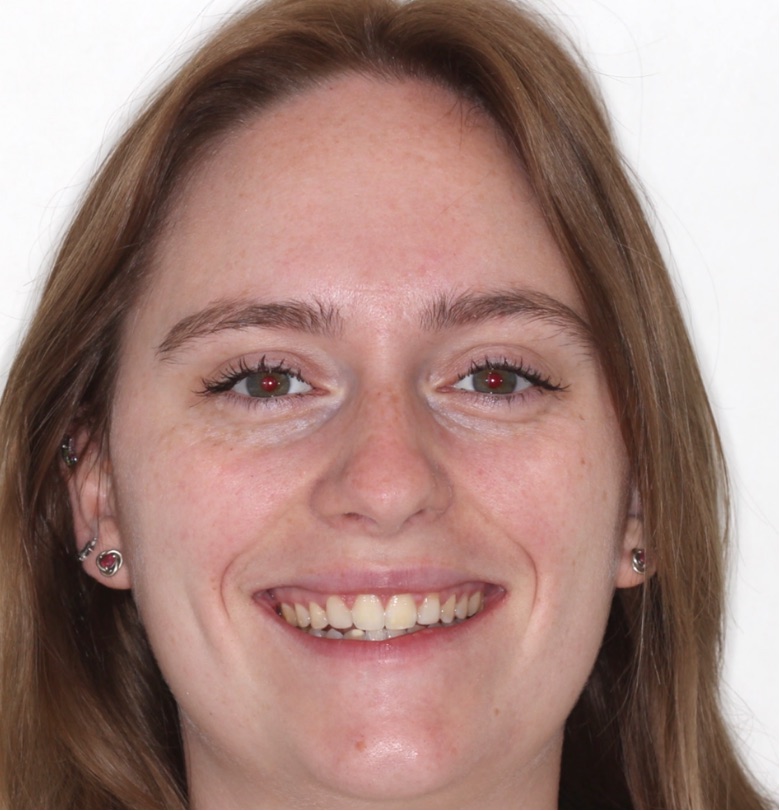 Go Orthodontics adult patient smiling before orthodontic treatment