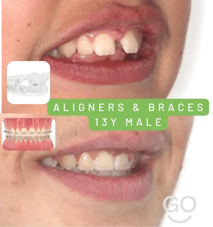 Dr Shaun Goh with teenage patients during orthodontic care