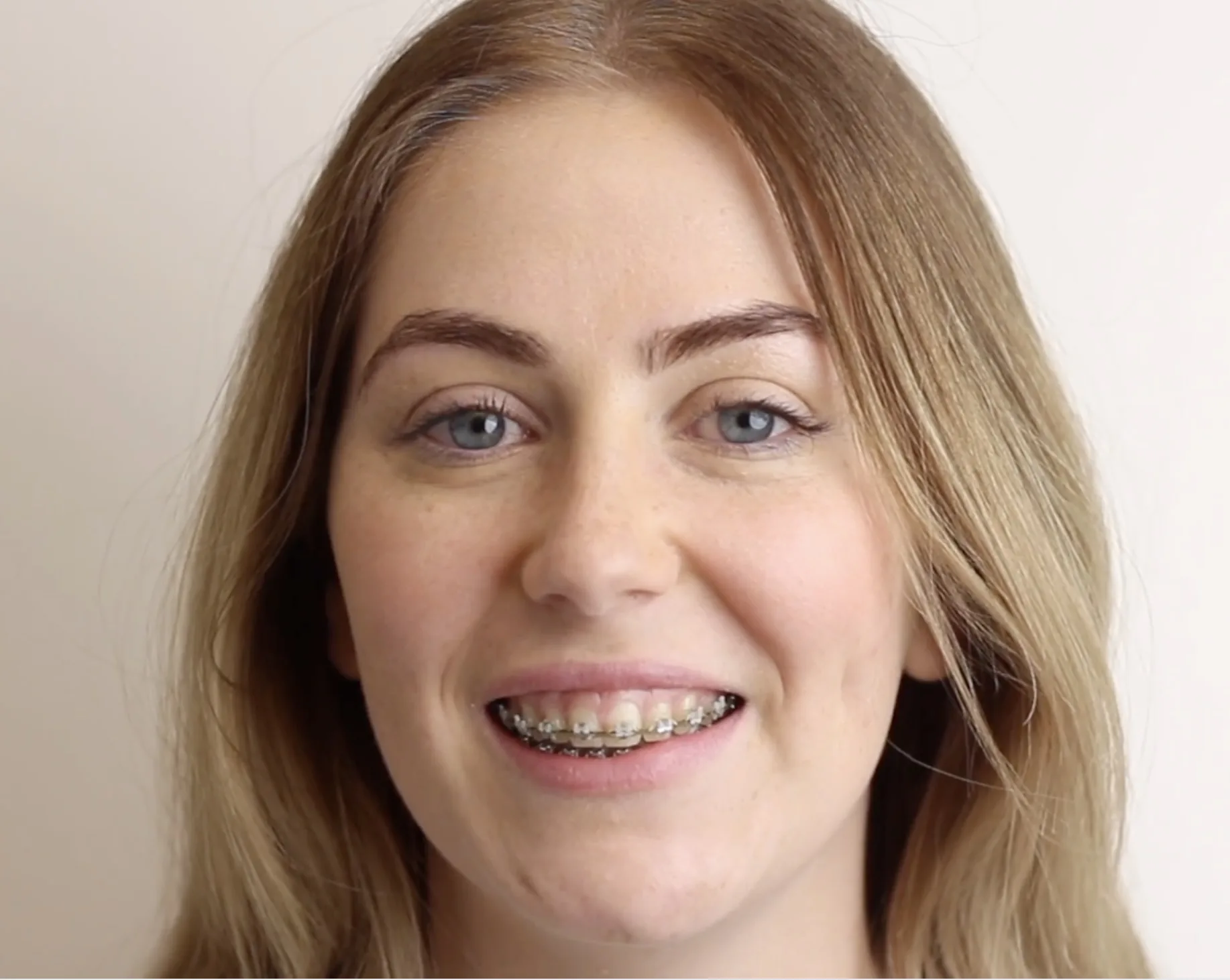 Go Orthodontics patient smiling with clear ceramic braces