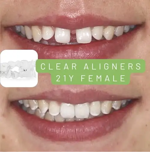 Before and after clear aligner treatment result