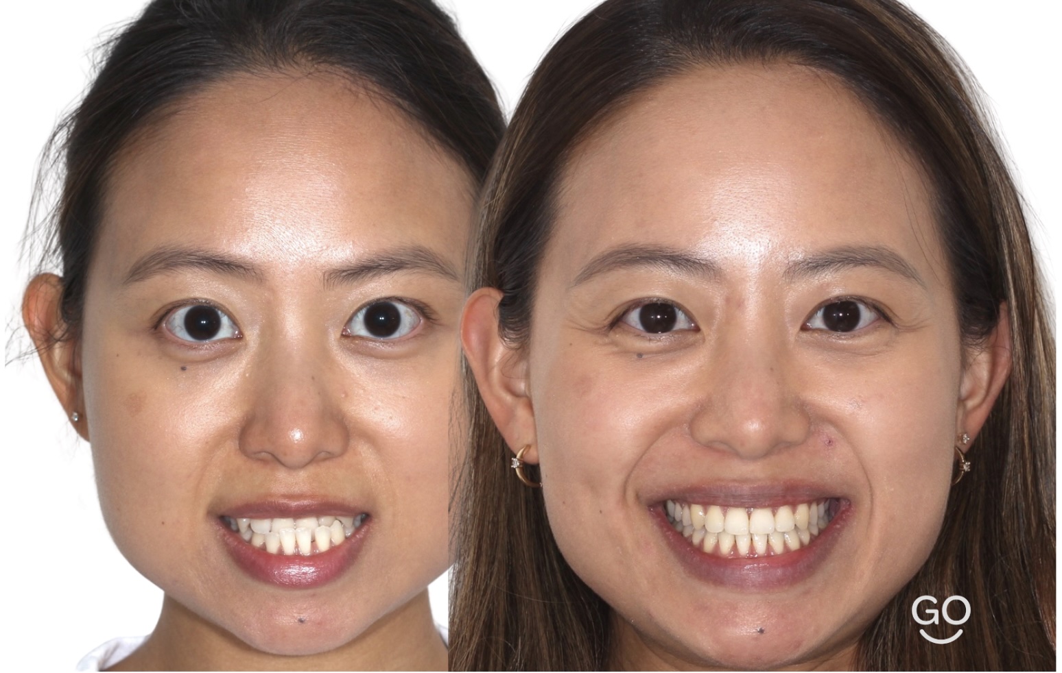 Before and after adult underbite correction with clear braces