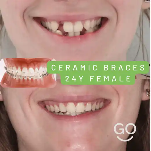 Before and after clear ceramic braces treatment result