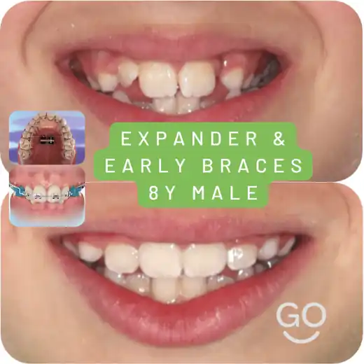 Early intervention orthodontic treatment with expander and braces