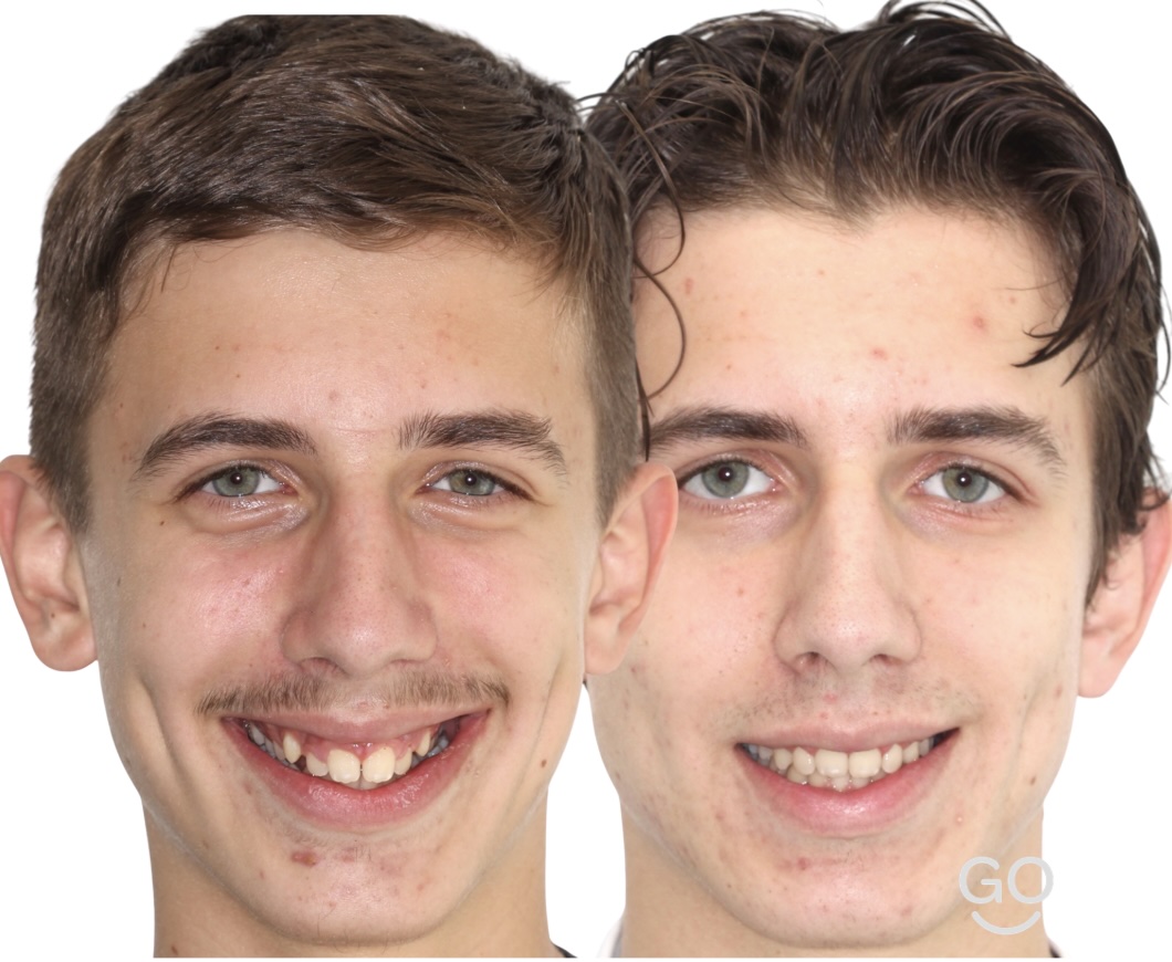 Before and after facial treatment result using metal braces for crowding and gummy smile correction