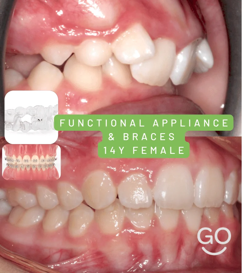 Close-up before and after photos showing straighter teeth that fit together more evenly