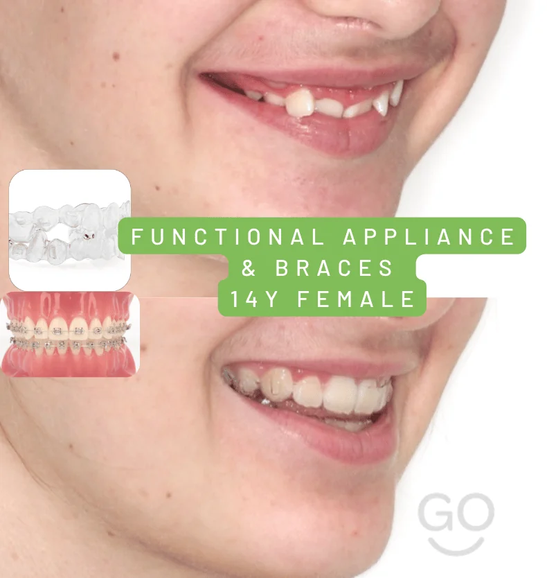 Before and after photos of a teenager’s smile