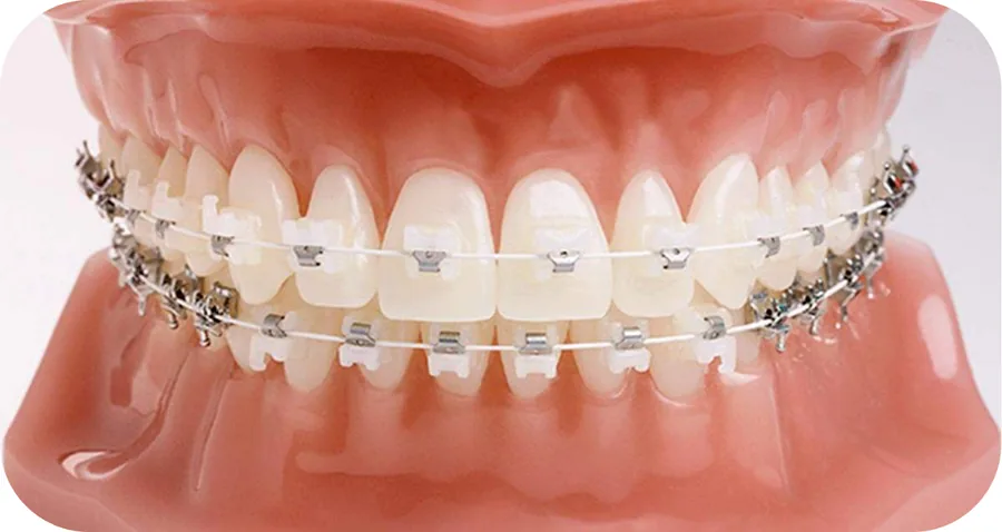 Clear ceramic braces