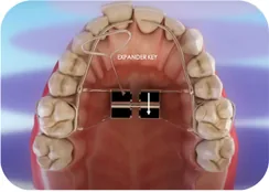 Rapid maxillary expander appliance