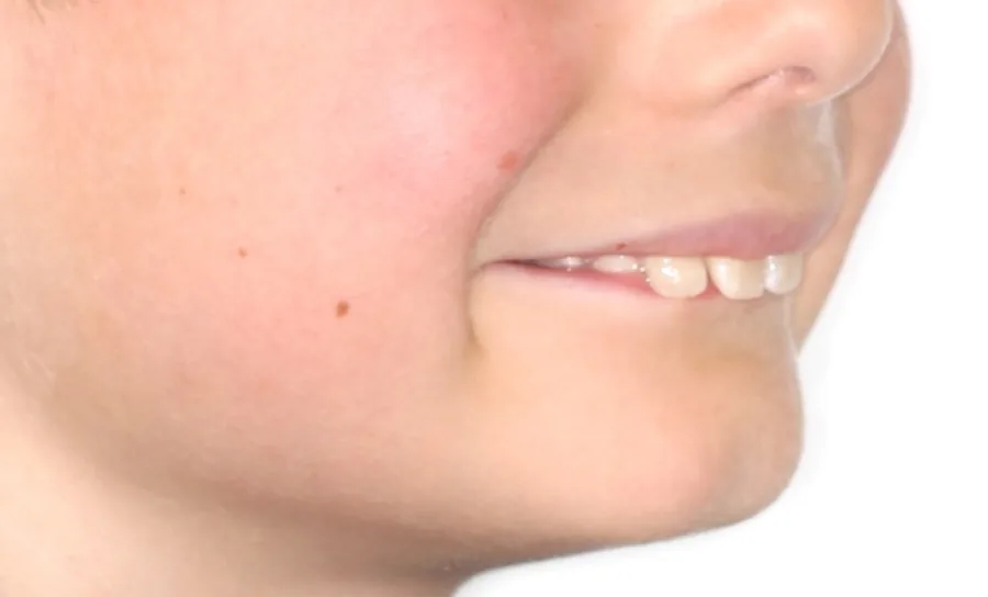 Growth modification orthodontic profile