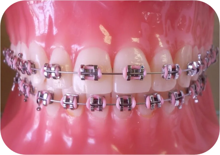 Metal braces
